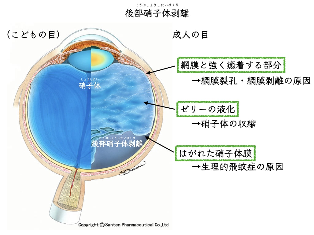 飛蚊症 網膜剥離 網膜裂孔をきたす確率 リスク たける眼科 福岡市早良区 高取商店街 西新駅 藤崎駅