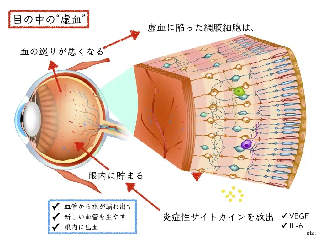 糖尿病網膜症の原因・治療：「高血糖は目の中の炎症を引き起こす」 | たける眼科 | 福岡市早良区 高取商店街［西新駅／藤崎駅］