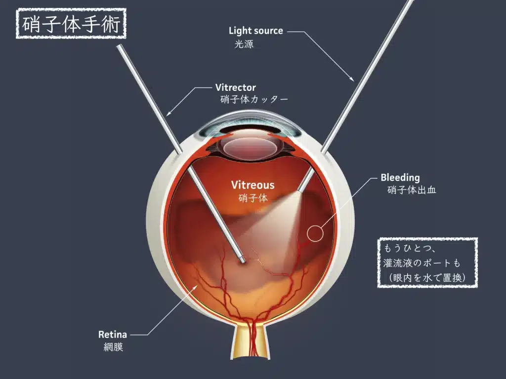 糖尿病網膜症の原因・治療：「高血糖は目の中の炎症を引き起こす」 | たける眼科 | 福岡市早良区 高取商店街［西新駅／藤崎駅］