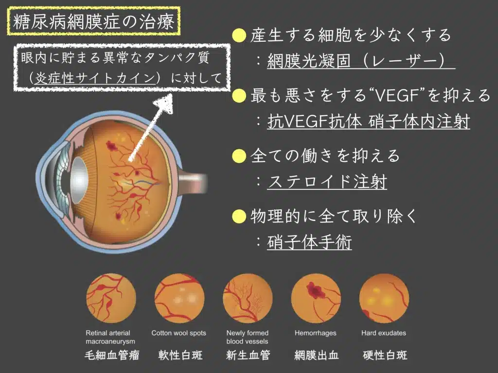 糖尿病網膜症の原因・治療：「高血糖は目の中の炎症を引き起こす」 | たける眼科 | 福岡市早良区 高取商店街［西新駅／藤崎駅］