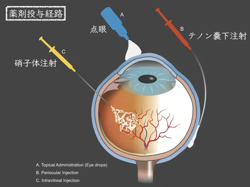 糖尿病網膜症の原因・治療：「高血糖は目の中の炎症を引き起こす」 | たける眼科 | 福岡市早良区 高取商店街［西新駅／藤崎駅］