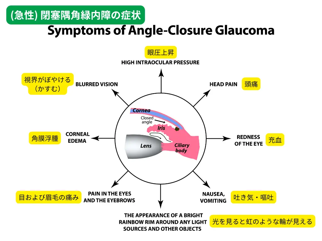 散瞳検査のあとの注意点：急性緑内障発作を起こす可能性・リスクとは | たける眼科 | 福岡市早良区 高取商店街［西新駅／藤崎駅］