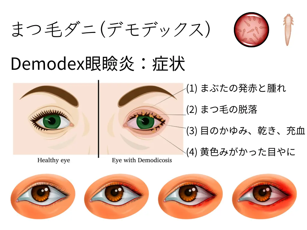 まつ毛ダニ：まつ毛を健康に保つ役割と、ドライアイへの関与 | たける眼科 | 福岡市早良区 高取商店街[西新駅／藤崎駅]