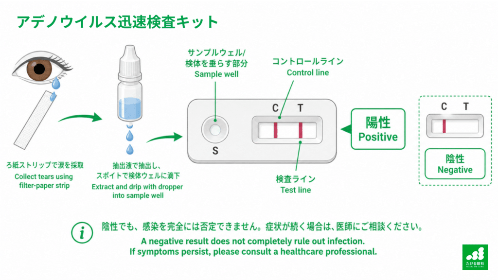 アデノウイルス迅速検査キットの検査手順と結果の見方(陽性・陰性)を示したイラスト