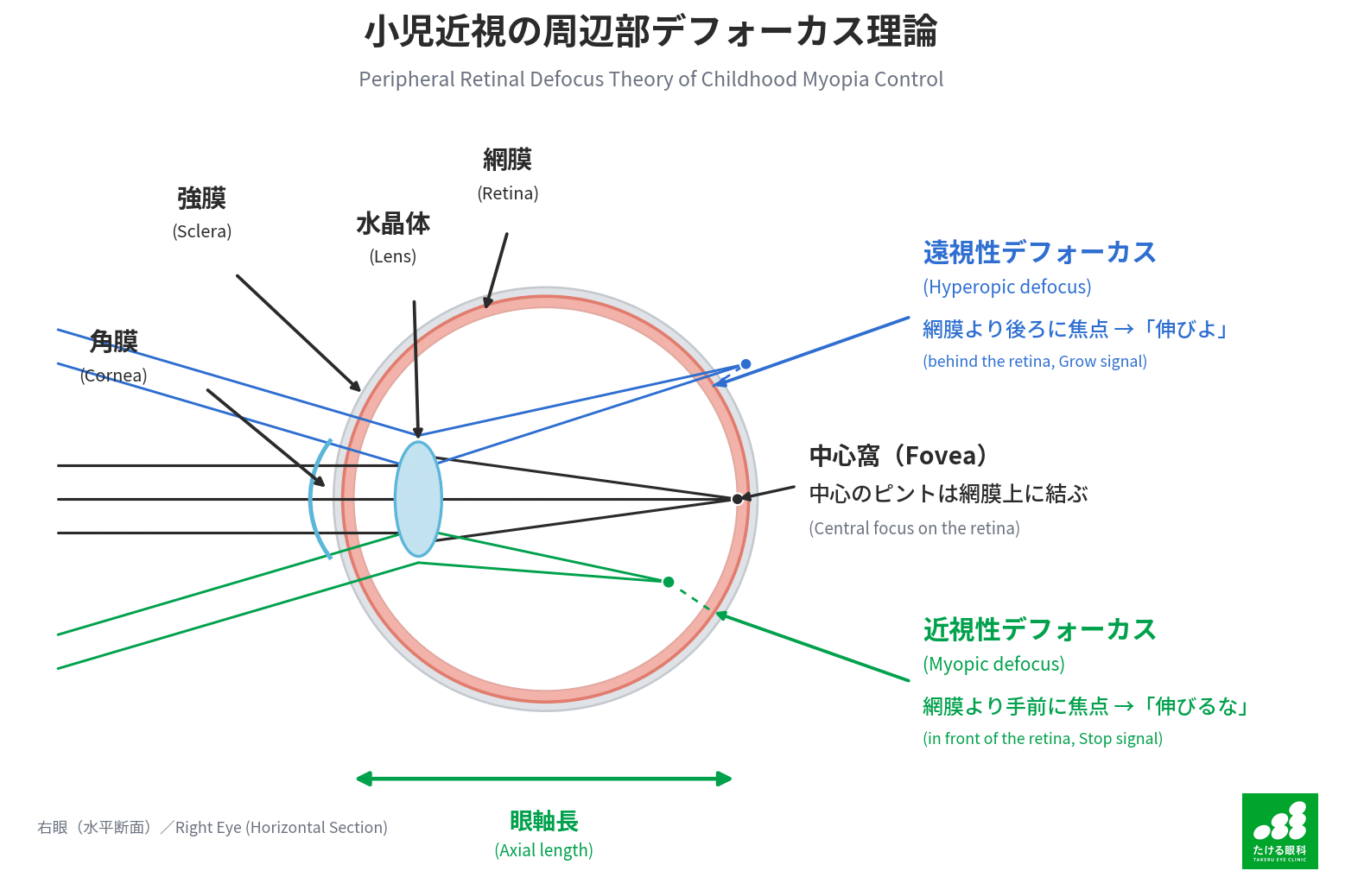 周辺部デフォーカス理論の模式図:中心はピントが合い、周辺の光は網膜の前で焦点を結ぶ(近視性デフォーカス)