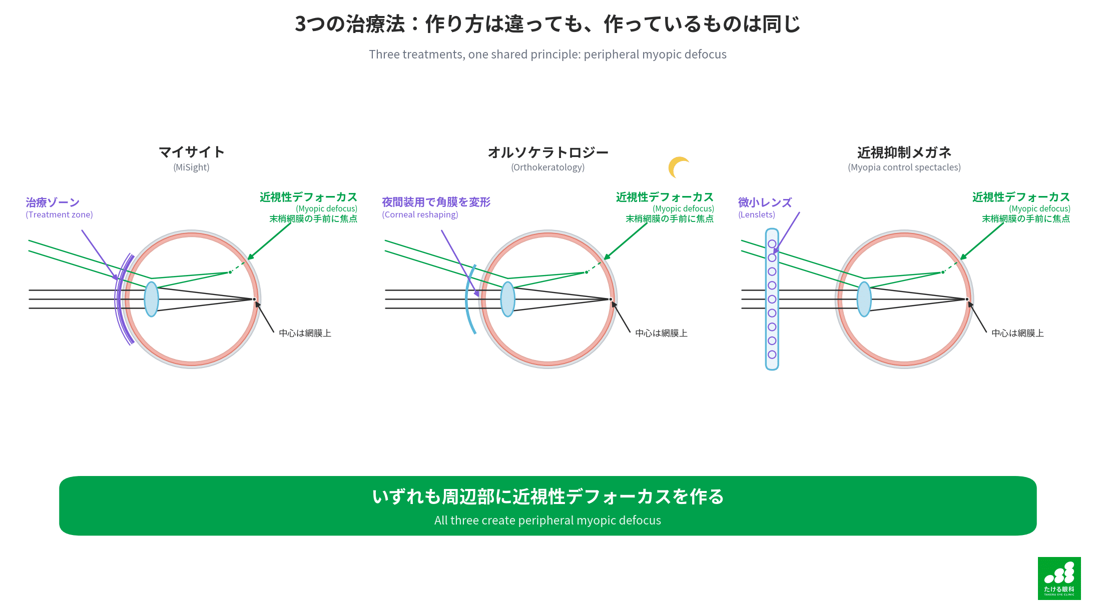 3つの近視抑制治療(マイサイト・オルソケラトロジー・近視抑制メガネ)の比較:いずれも周辺部に近視性デフォーカスを作る