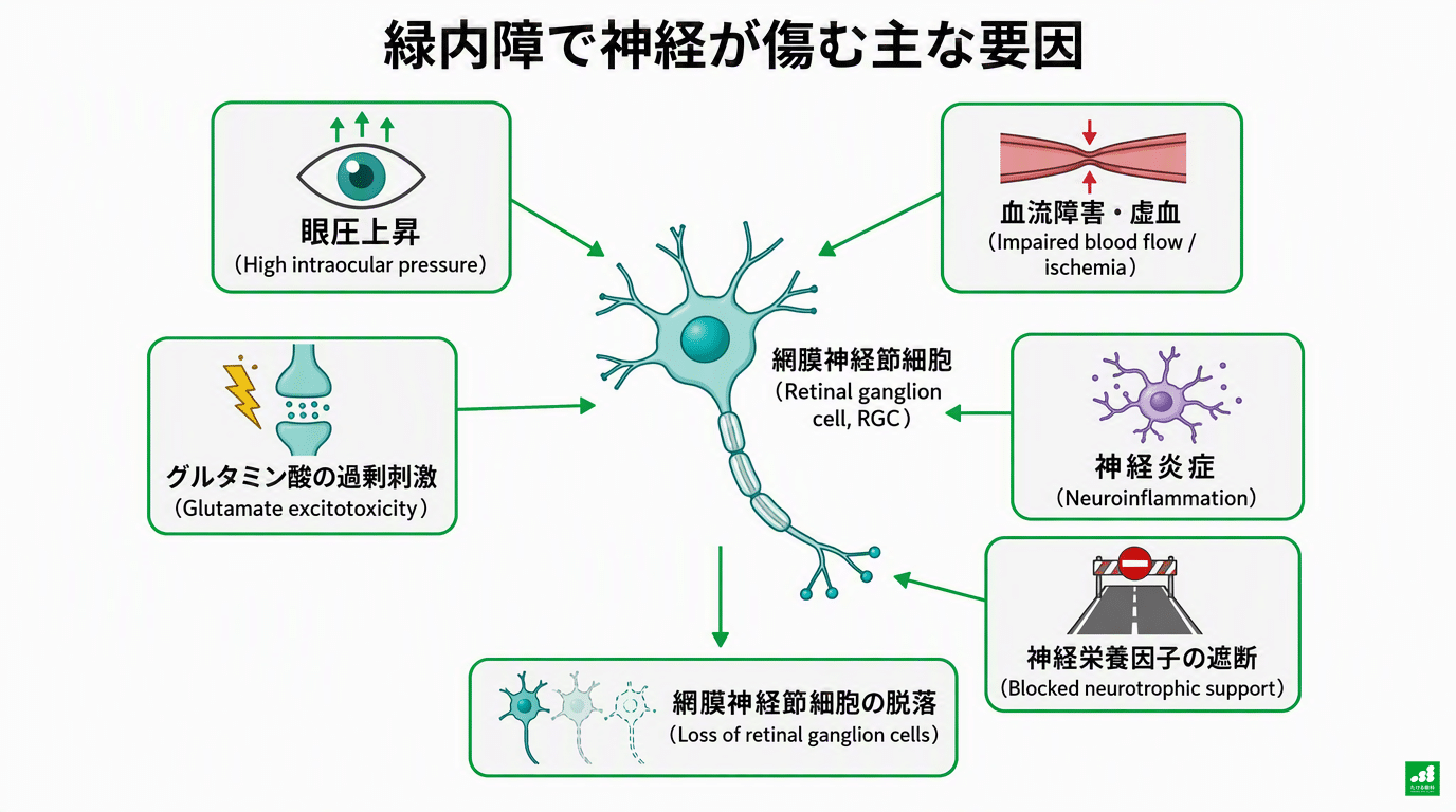 緑内障で神経が傷む主な要因の模式図(日英併記):眼圧上昇・血流障害/虚血・グルタミン酸の過剰刺激・神経炎症・神経栄養因子の遮断の5つの要因が網膜神経節細胞(RGC)に集まり、RGCの脱落に至ることを示すオリジナル図