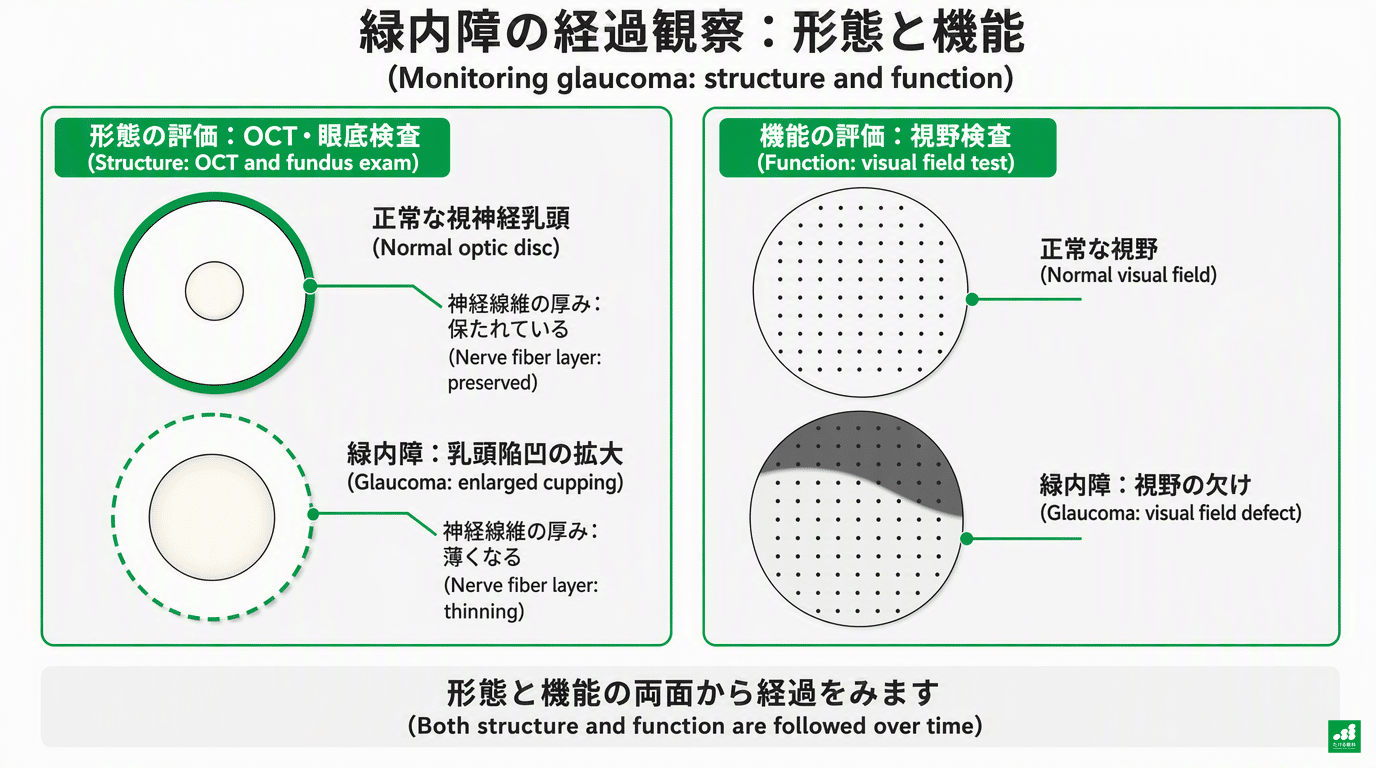 緑内障の経過観察の模式図(日英併記):形態の評価(OCT・眼底検査。正常な視神経乳頭と緑内障の乳頭陥凹拡大・神経線維の菲薄化)と機能の評価(視野検査。正常視野と弓状の視野欠損)を左右2パネルで比較するオリジナル図