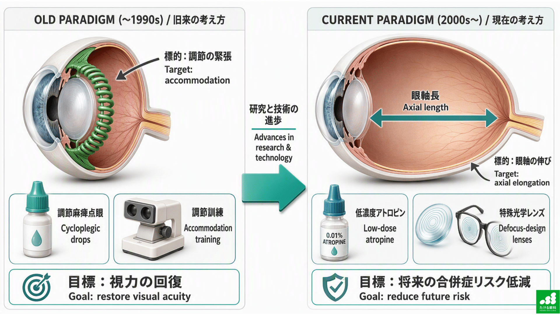 昔の考え方(毛様体筋の緊張をほぐす)と現在の考え方(眼軸長の伸びを抑える)を対比した図