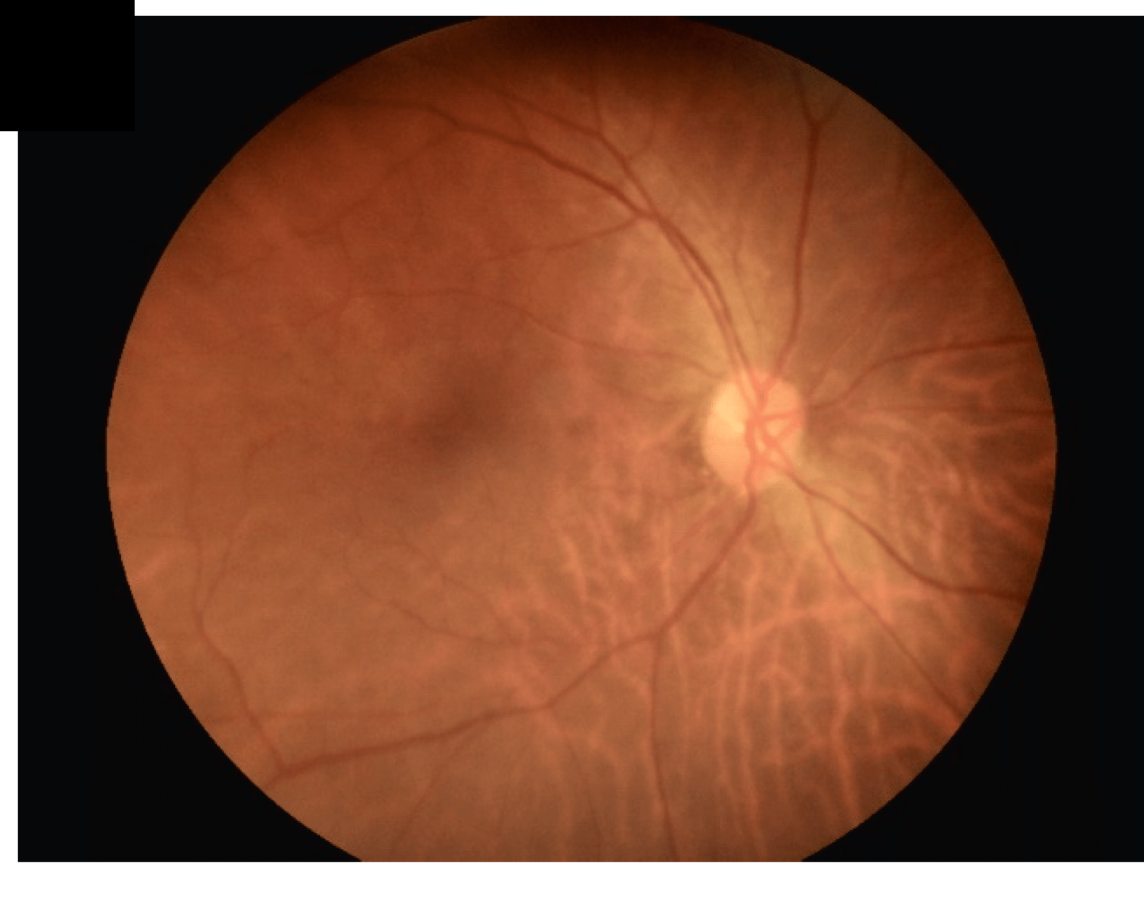 Normal fundus photograph: the optic disc and macula are visible