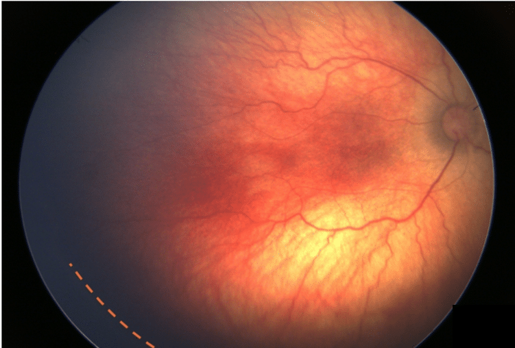 Fundus photograph of retinopathy of prematurity (ROP): dilated, tortuous posterior retinal vessels and a demarcation line