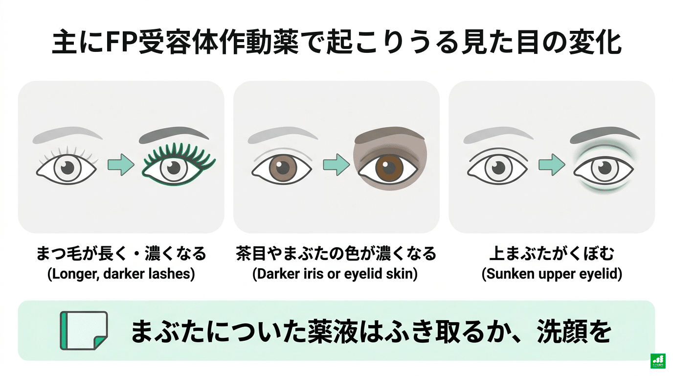 主にFP受容体作動薬で起こりうる見た目の変化を示した図。まつ毛が長く・濃くなる、茶目やまぶたの色が濃くなる、上まぶたがくぼむ。まぶたについた薬液はふき取るか洗顔する