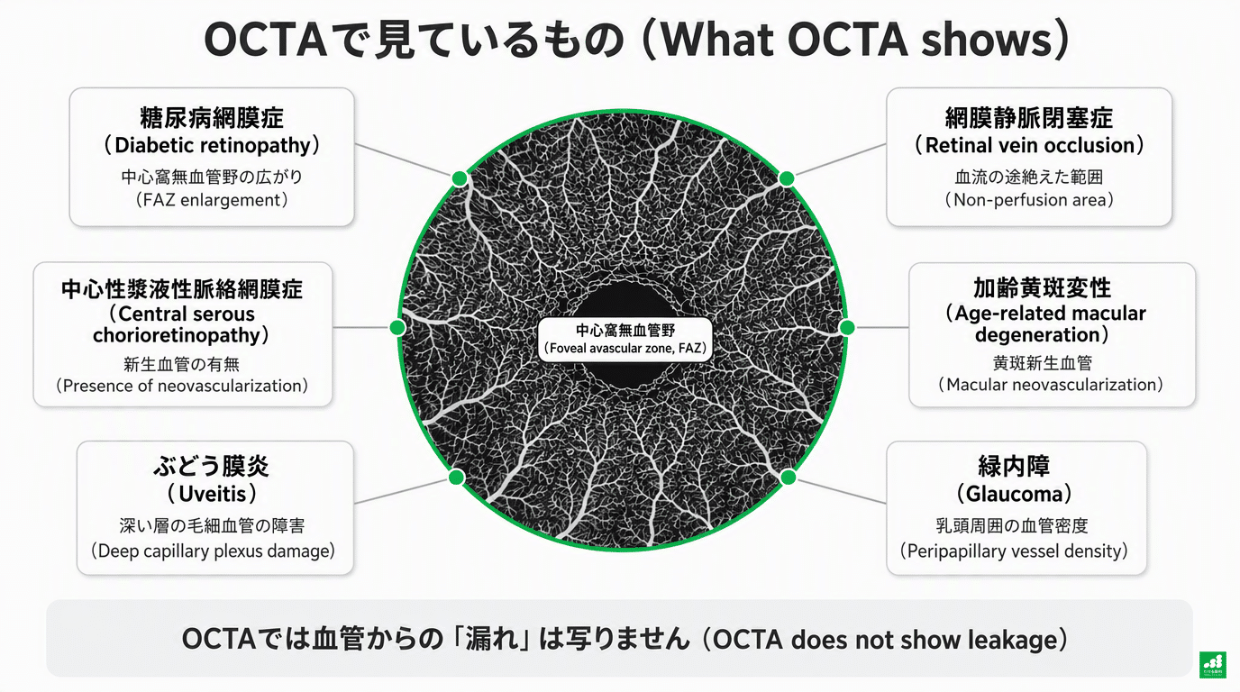 OCTAで見ているものの図解:中央にOCTAの画像と中心窩無血管野(FAZ)。周りに、糖尿病網膜症(中心窩無血管野の広がり)、網膜静脈閉塞症(血流の途絶えた範囲)、加齢黄斑変性(黄斑新生血管)、緑内障(乳頭周囲の血管密度)、ぶどう膜炎(深い層の毛細血管の障害)、中心性漿液性脈絡網膜症(新生血管の有無)。下に「OCTAでは血管からの漏れは写りません」