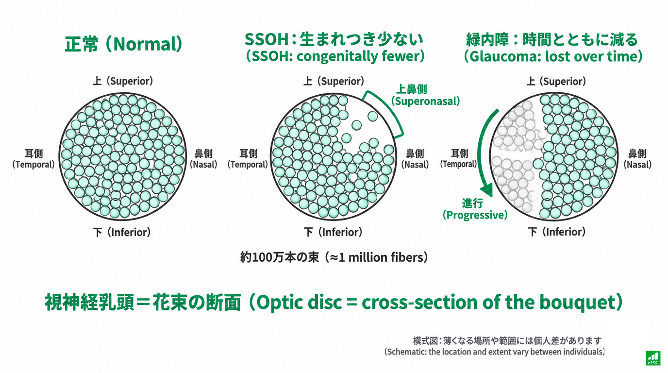 右眼の視神経乳頭を花束の断面に見立てた模式図。正常、SSOH(上鼻側の線維が生まれつき少ない)、緑内障(耳側の上下から進行性に減る)の3枚を、上・下・耳側・鼻側をそろえて比較